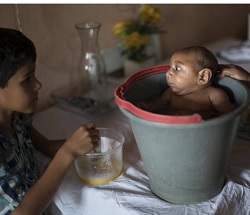 AP photographer reflects on ‘bucket baby’ in Brazil